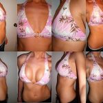 Breast Augmentation Before and After